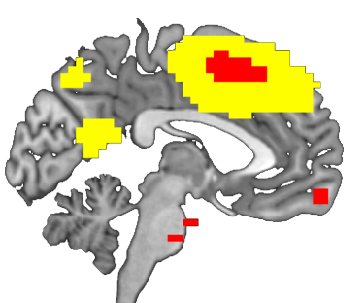 A fMRI marker may predict the outcome of electroconvulsive therapy in severe and treatment-resistant depression