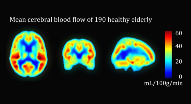 Clinical use of Arterial Spin Labeling 2
