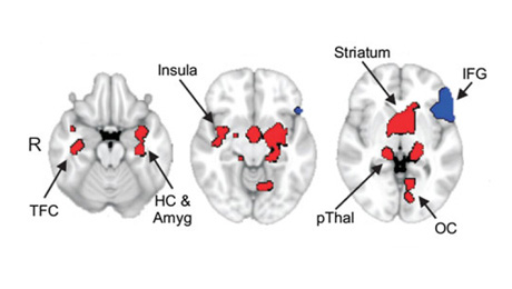 ASD and ADHD traits reflected in brain of typical adults 1