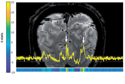 A line through the brain